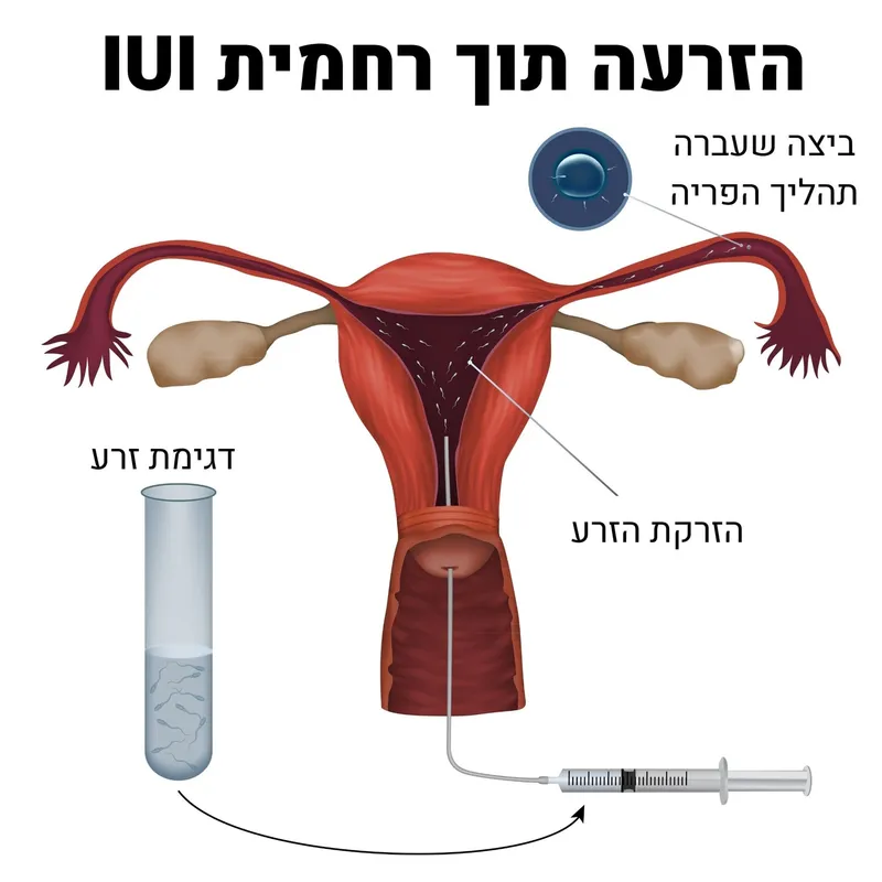 הזרעה תוך רחמית IUI